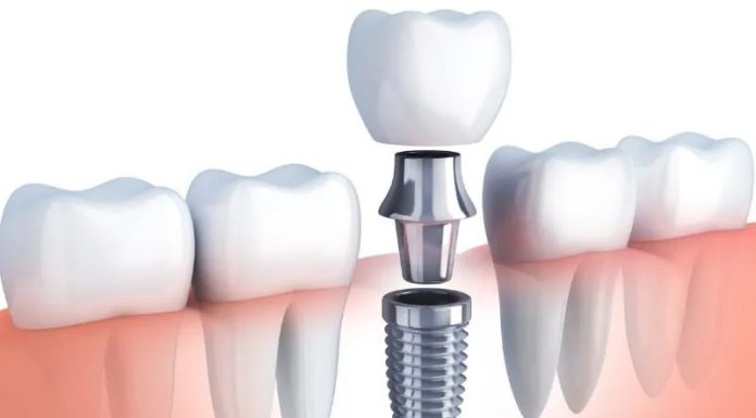 Tooth Extractions and Preservation: Ensuring Optimal Oral Health and Function