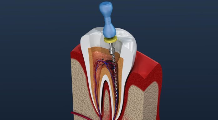 Beyond Expectations: Experience the Best Root Canal Treatment