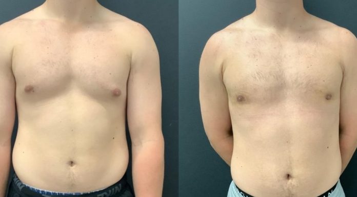 Maintaining Long-Term Results After Gynecomastia Surgery