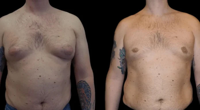 Understanding Male Breast Reduction Surgery: Causes and Treatments