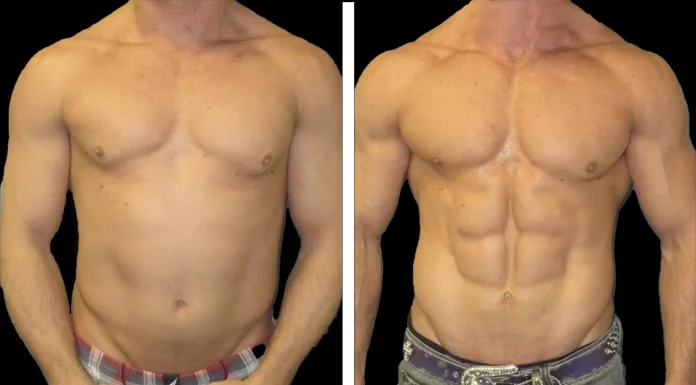 Are The Results Of An Abdominal Etching Permanent